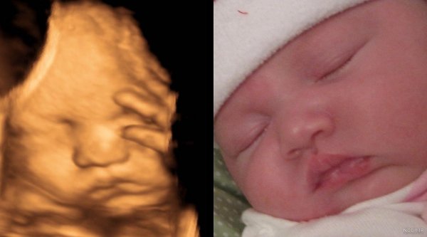  عکس سونوگرافی پسر