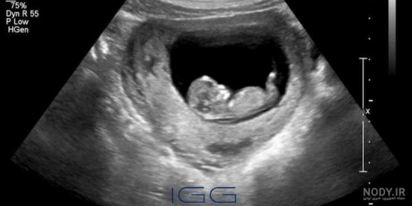  عکس سونوگرافی پسر