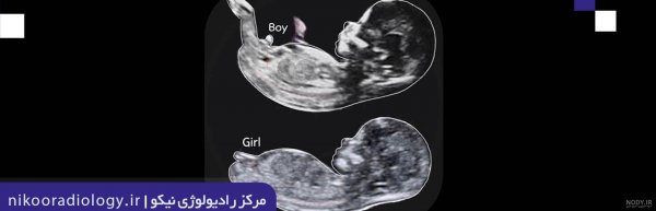  عکس سونوگرافی پسر