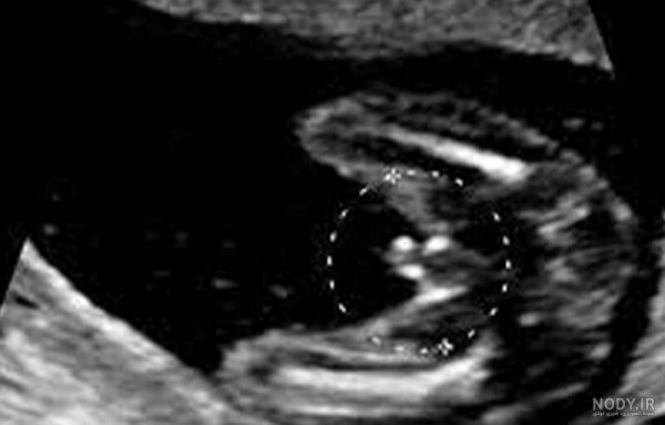  عکس سونوگرافی پسر