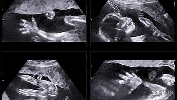  عکس سونوگرافی پسر