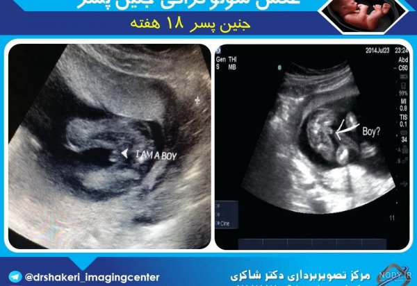  عکس سونوگرافی پسر