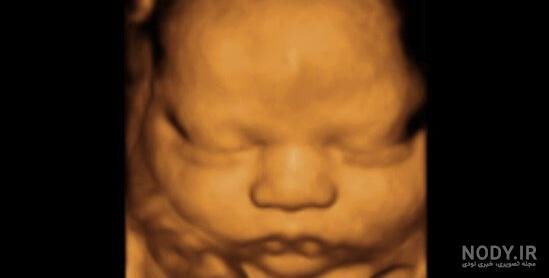  عکس سونوگرافی پسر