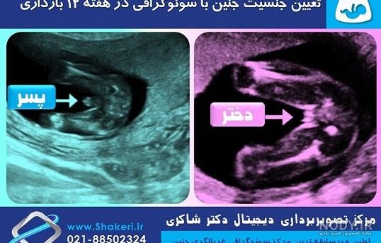  عکس سونوگرافی پسر