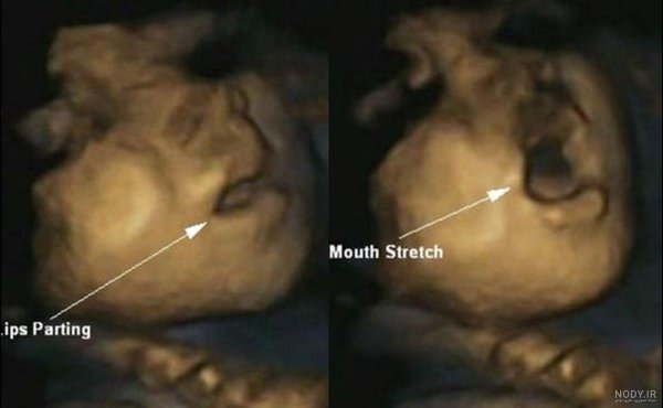  عکس سونوگرافی پسر