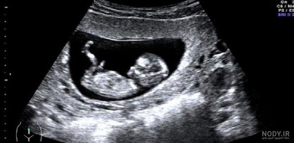  عکس سونوگرافی پسر