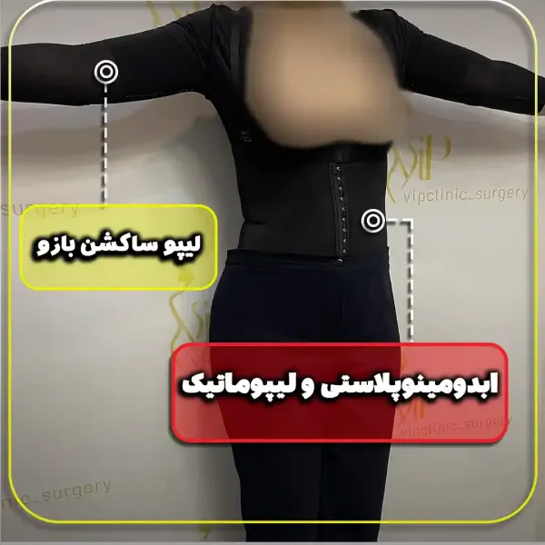  عکس قبل و بعد لاغری شکم