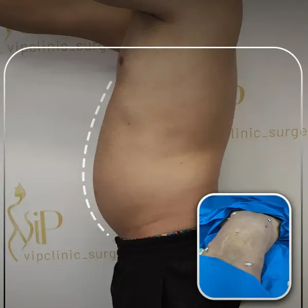  عکس قبل و بعد لاغری شکم