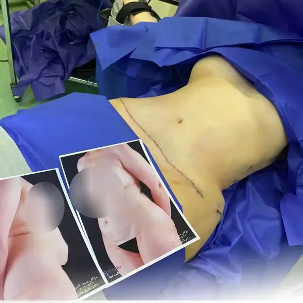  عکس قبل و بعد لاغری شکم