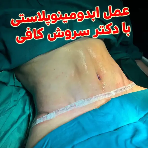  عکس قبل و بعد لاغری شکم