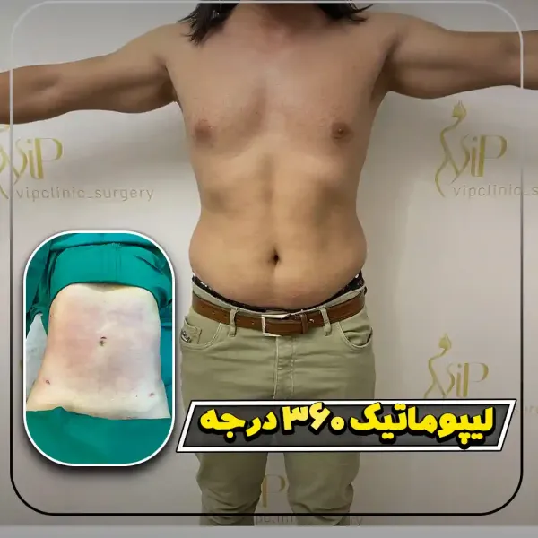  عکس قبل و بعد ساکشن شکم و پهلو