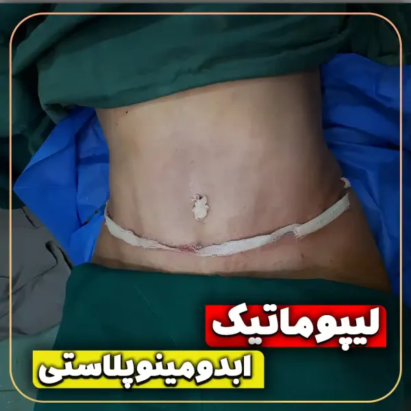  عکس قبل و بعد ساکشن شکم و پهلو