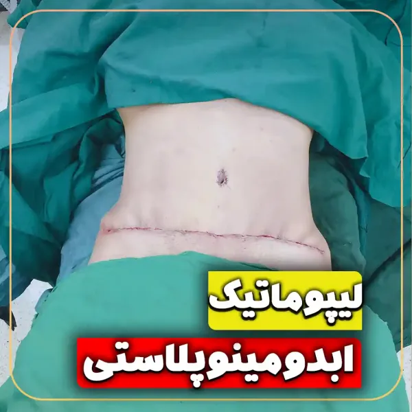  عکس قبل و بعد ساکشن شکم و پهلو