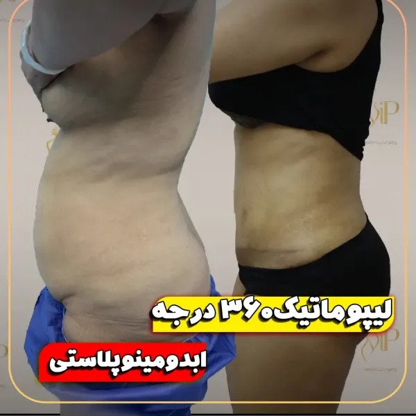  عکس قبل و بعد ساکشن شکم و پهلو