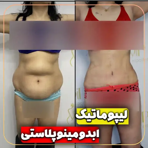 عکس قبل و بعد لیپوماتیک شکم