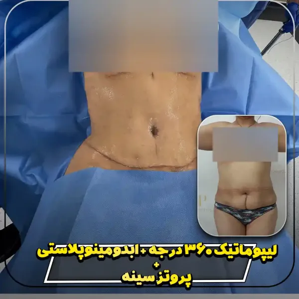 عکس قبل و بعد لیپوماتیک شکم