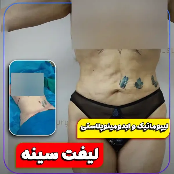  عکس جراحی شکم زن