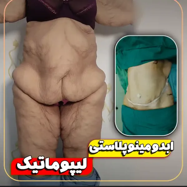 عکس قبل و بعد لیپوماتیک شکم