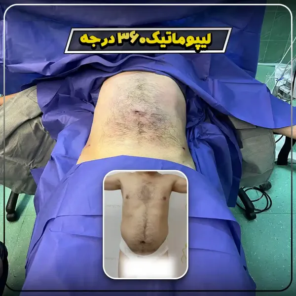  عکس قبل و بعد لیپوماتیک شکم
