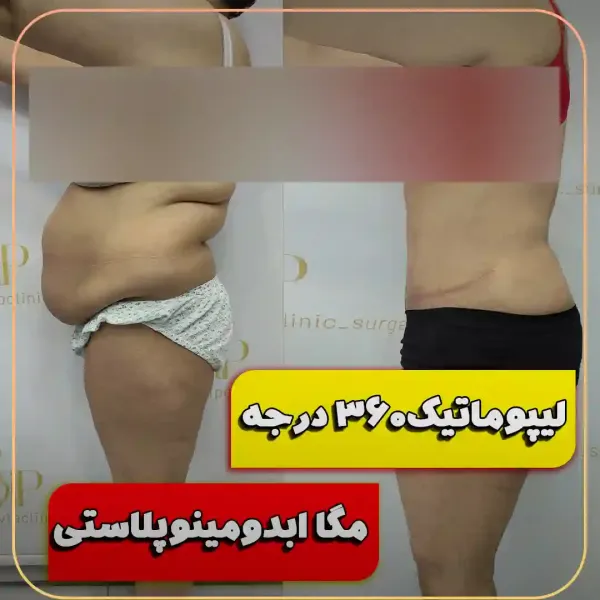  عکس قبل و بعد لیپوماتیک شکم