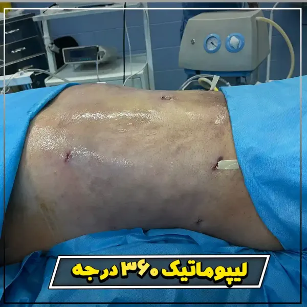  عکس قبل و بعد لیپوماتیک شکم