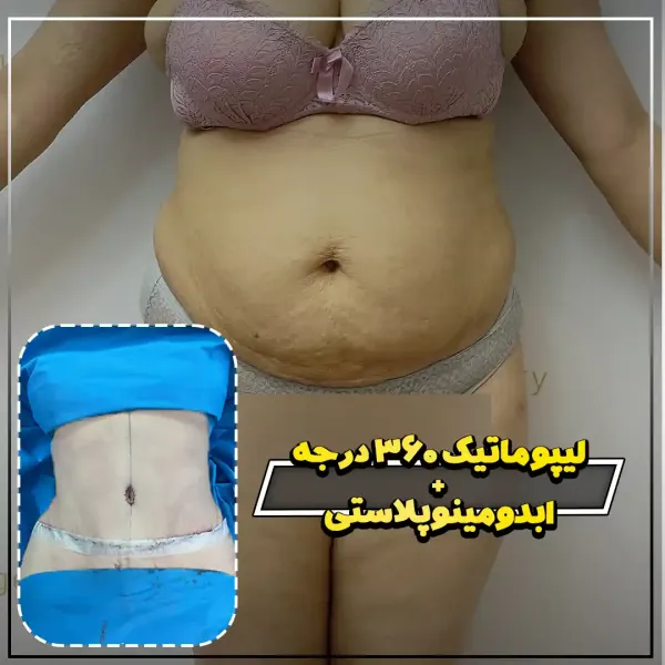  عکس قبل و بعد لیپوماتیک شکم