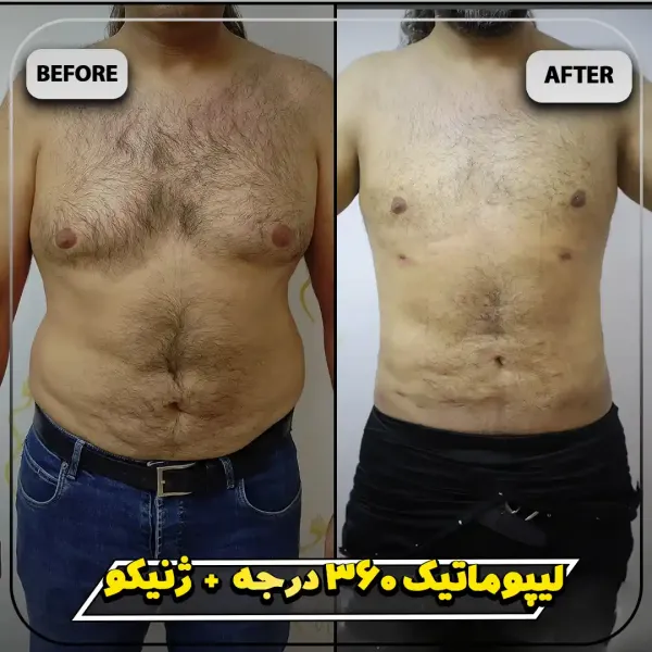  عکس قبل و بعد لیپوماتیک شکم