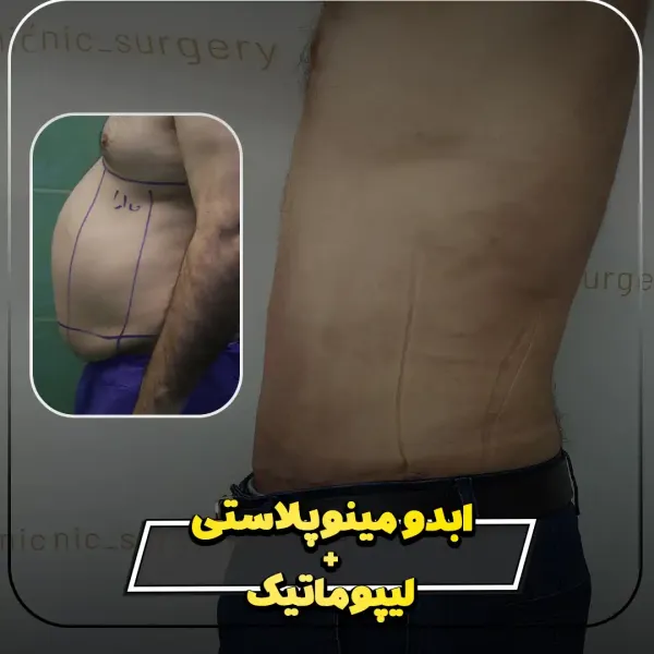  عکس بعد از عمل ابدو