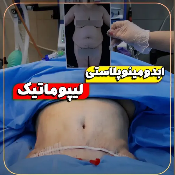  عکس بعد از عمل ابدو