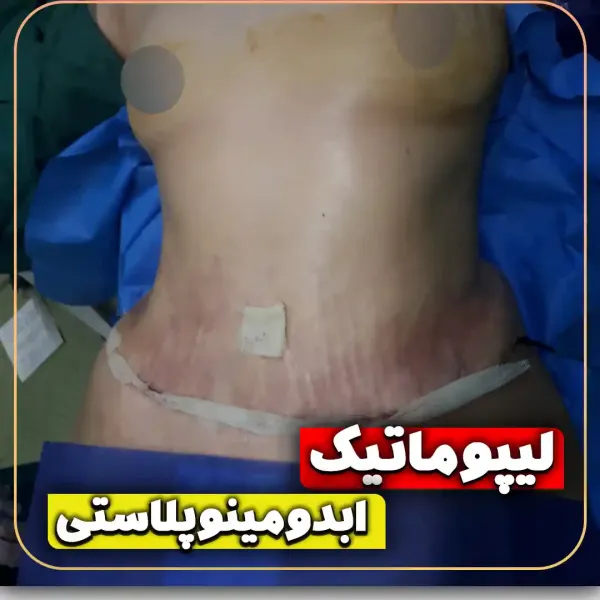  عکس بعد از عمل ابدو