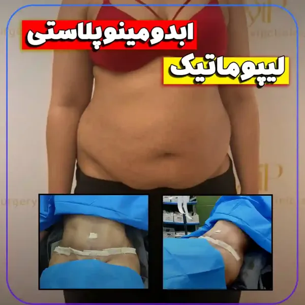  عکس بعد از عمل ابدو