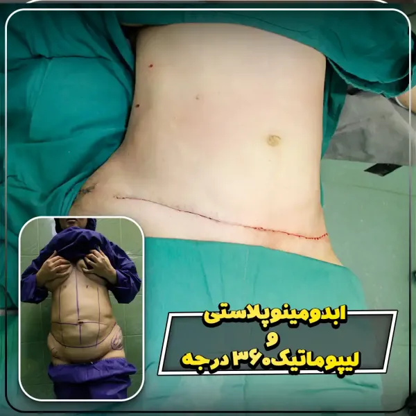  عکس بعد از عمل ابدو