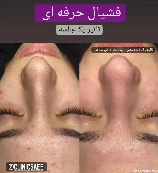  عکس فیشیال صورت قبل و بعد