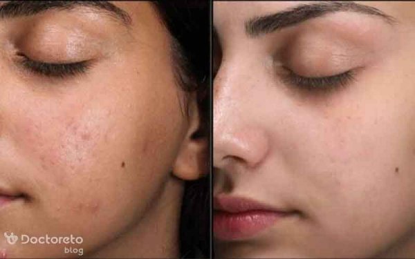  عکس فیشیال صورت قبل و بعد