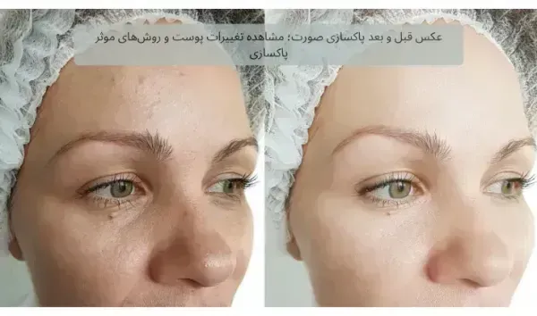  عکس فیشیال صورت قبل و بعد