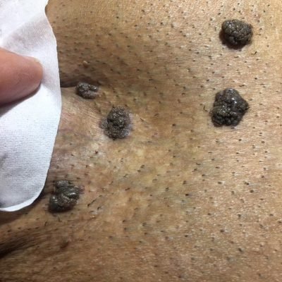  20 عکس زگیل تناسلی زنان و مردان واضح