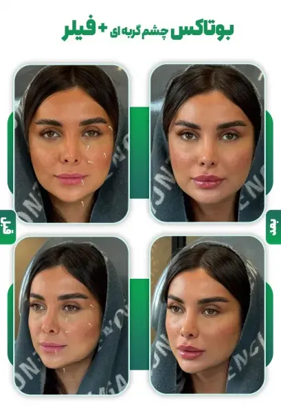  عکس بوتاکس چشم گربه ای
