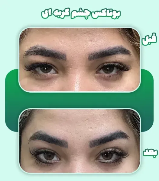 عکس بوتاکس چشم گربه ای