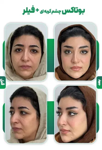  عکس بوتاکس چشم گربه ای