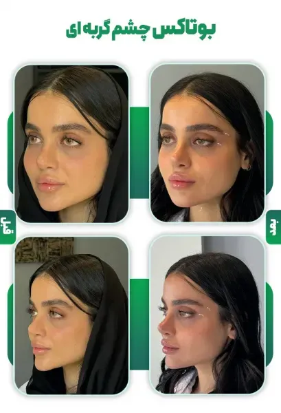  عکس بوتاکس چشم گربه ای