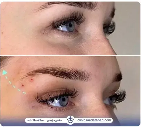  عکس بوتاکس چشم گربه ای