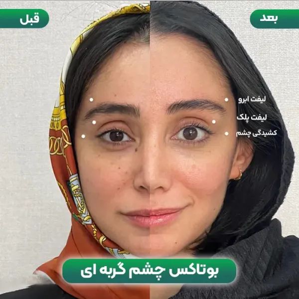  عکس قبل و بعد بوتاکس چشم گربه ای