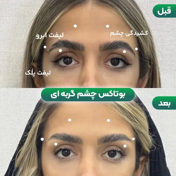  عکس قبل و بعد بوتاکس چشم گربه ای