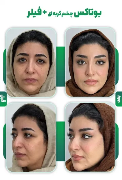  عکس قبل و بعد بوتاکس چشم گربه ای