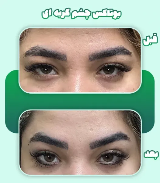  عکس قبل و بعد بوتاکس چشم گربه ای