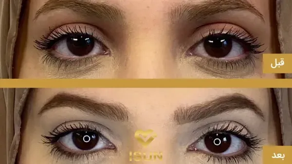  عکس قبل و بعد بوتاکس چشم گربه ای
