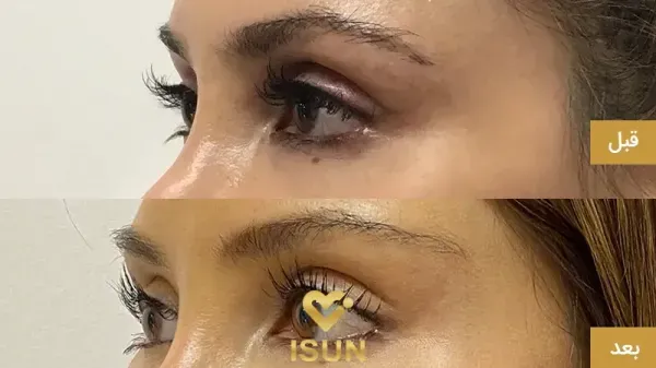  عکس قبل و بعد بوتاکس چشم گربه ای