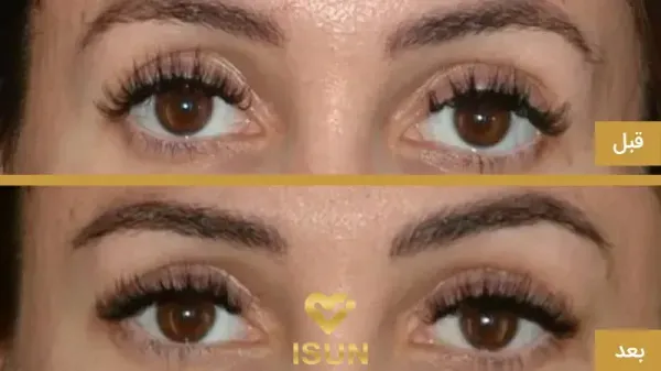  عکس قبل و بعد بوتاکس چشم گربه ای