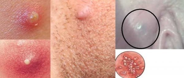 عکس جوش لبه داخلی واژن
