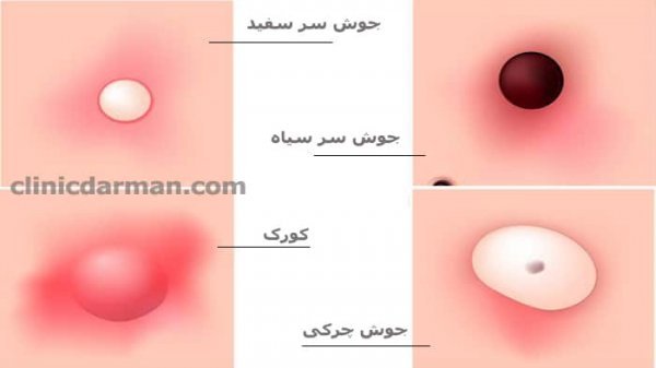 عکس جوش سر سفید در ناحیه تناسلی زنان